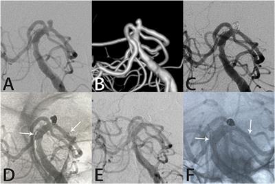 Neuroform atlas stent-assisted coiling of tiny wide-necked intracranial aneurysms